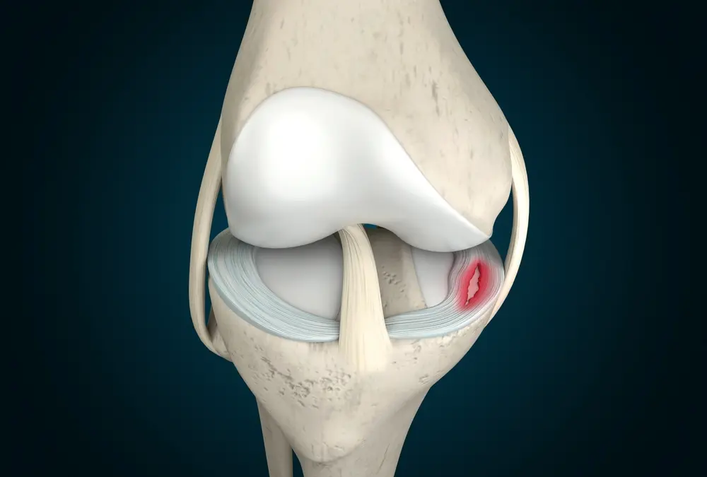 torn meniscus.